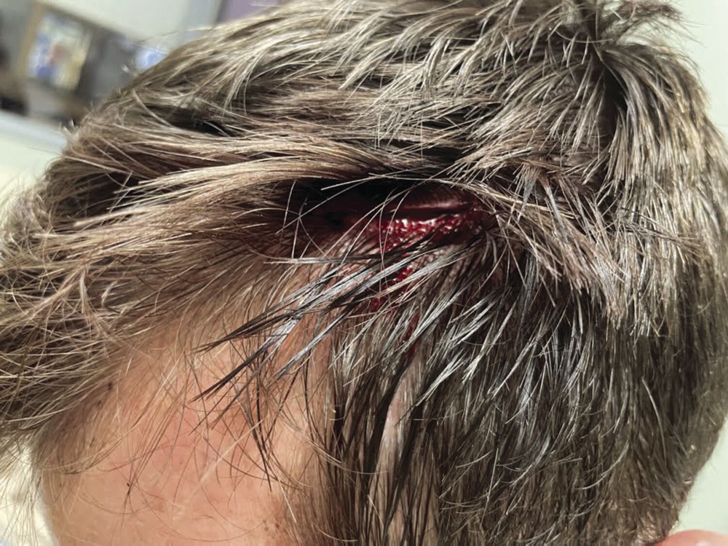 Glen camper clawed by bear in his tent